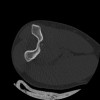 SPORK, NICO - 22.03.1976 - 02.08.2022 - CT obere Extremität - 17:51:17